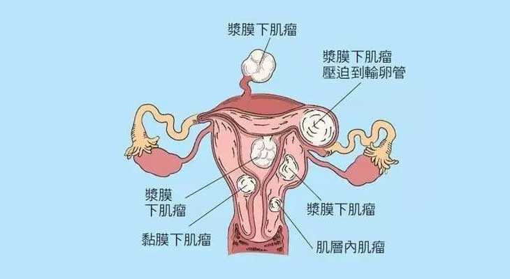 龙山县最好的代孕机构排名,崇左45岁做试管婴儿检查发现子宫长了瘤子，能不做