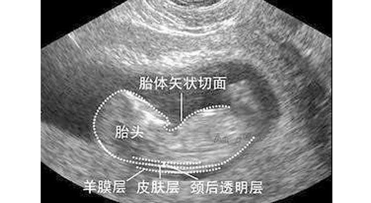 樊城区做代妈有哪些风险_樊城区漂亮代妈_试管怀孕后，NT检查是什么？有什么
